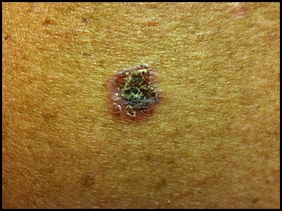 melanoma marcy mammay