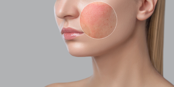 Ace Ferulic Before After