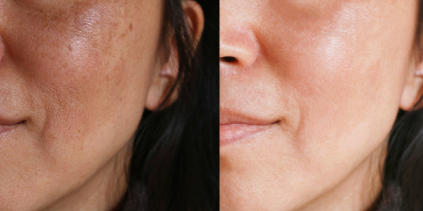 Juvabrite Before After