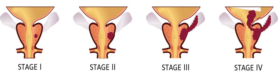 Prostate Cancer Stages