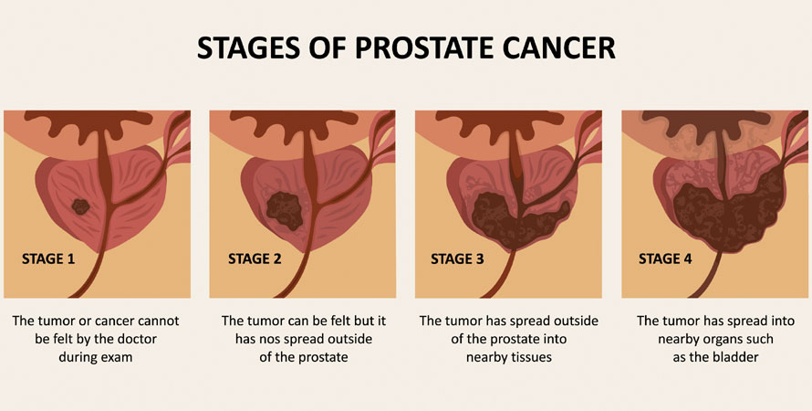 Prostate Cancer Stages of Development