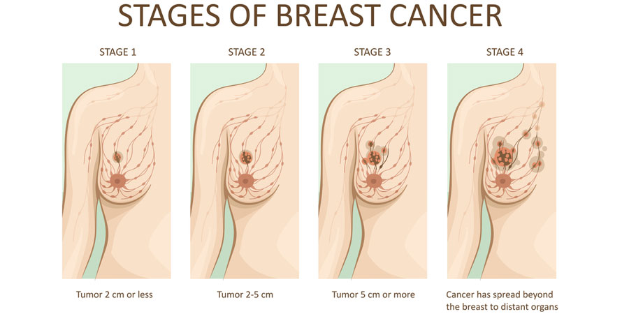 Stages Of Breast Cancer