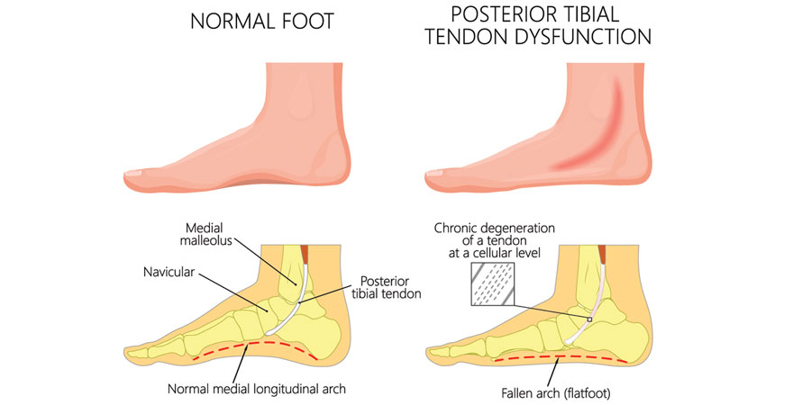 Tibialis posterior dysfunction