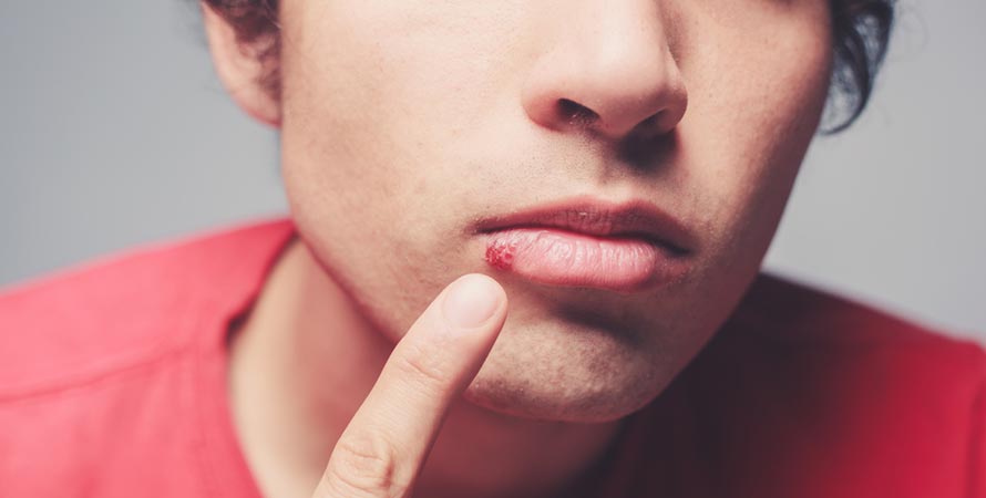 Fever blister on the lip