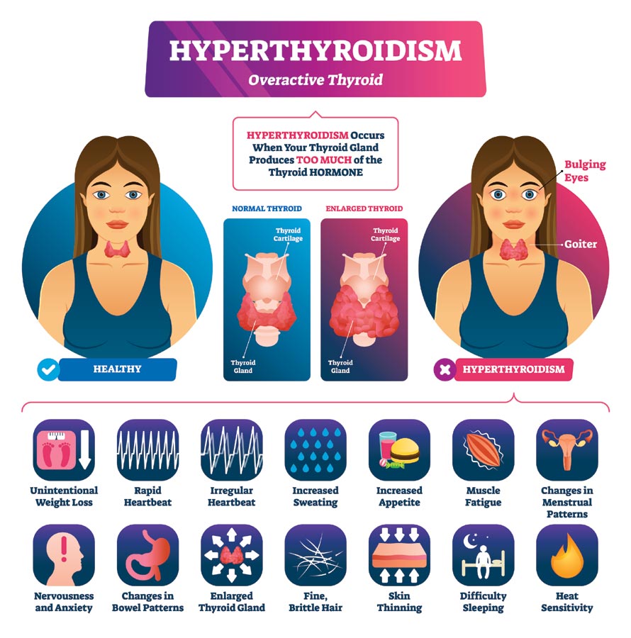Overactive Thyroid