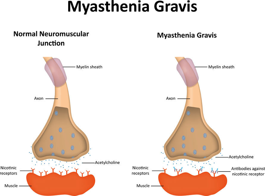 Types Of Myasthenia Gravis
