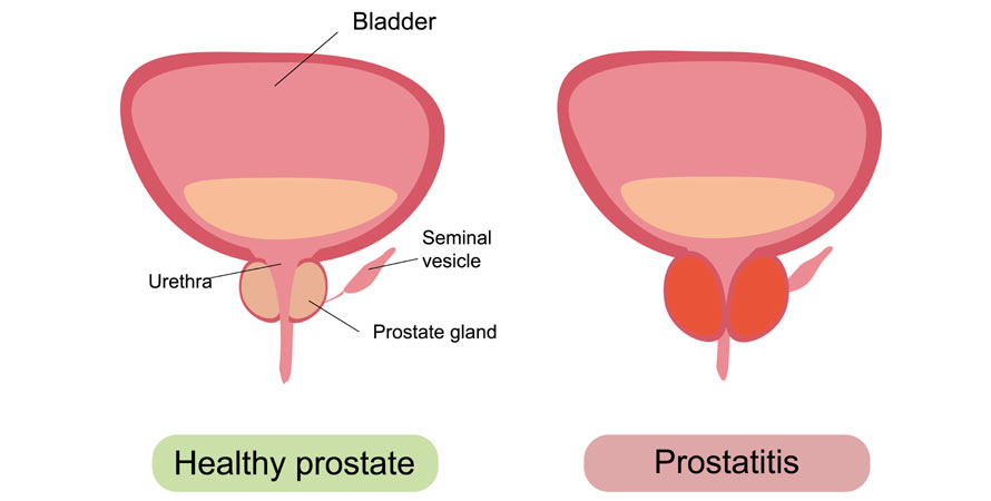 Thickened bladder