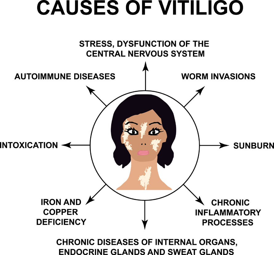 etiology of Vitiligo