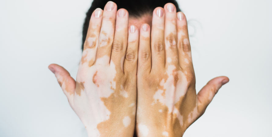 Prevent Vitiligo