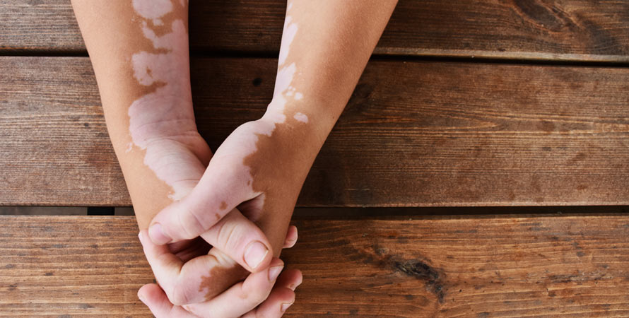 Vitiligo Genetic