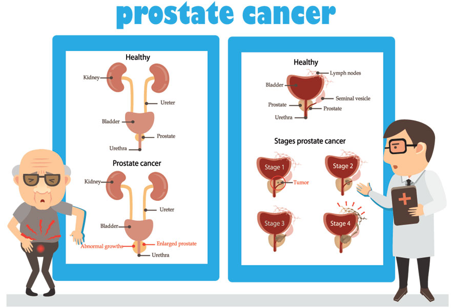 Prostate cancer