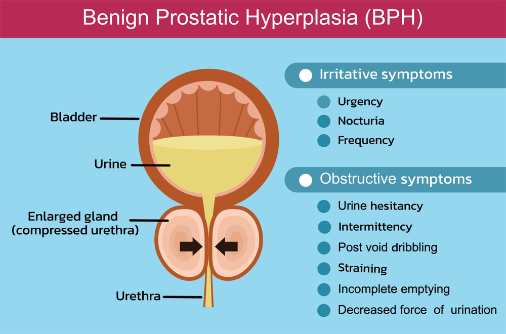 Prostatic hyperplasia