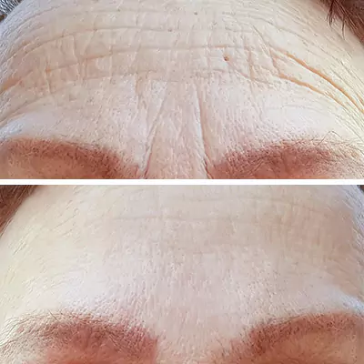 before-after