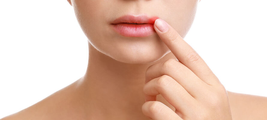 Cold Sore