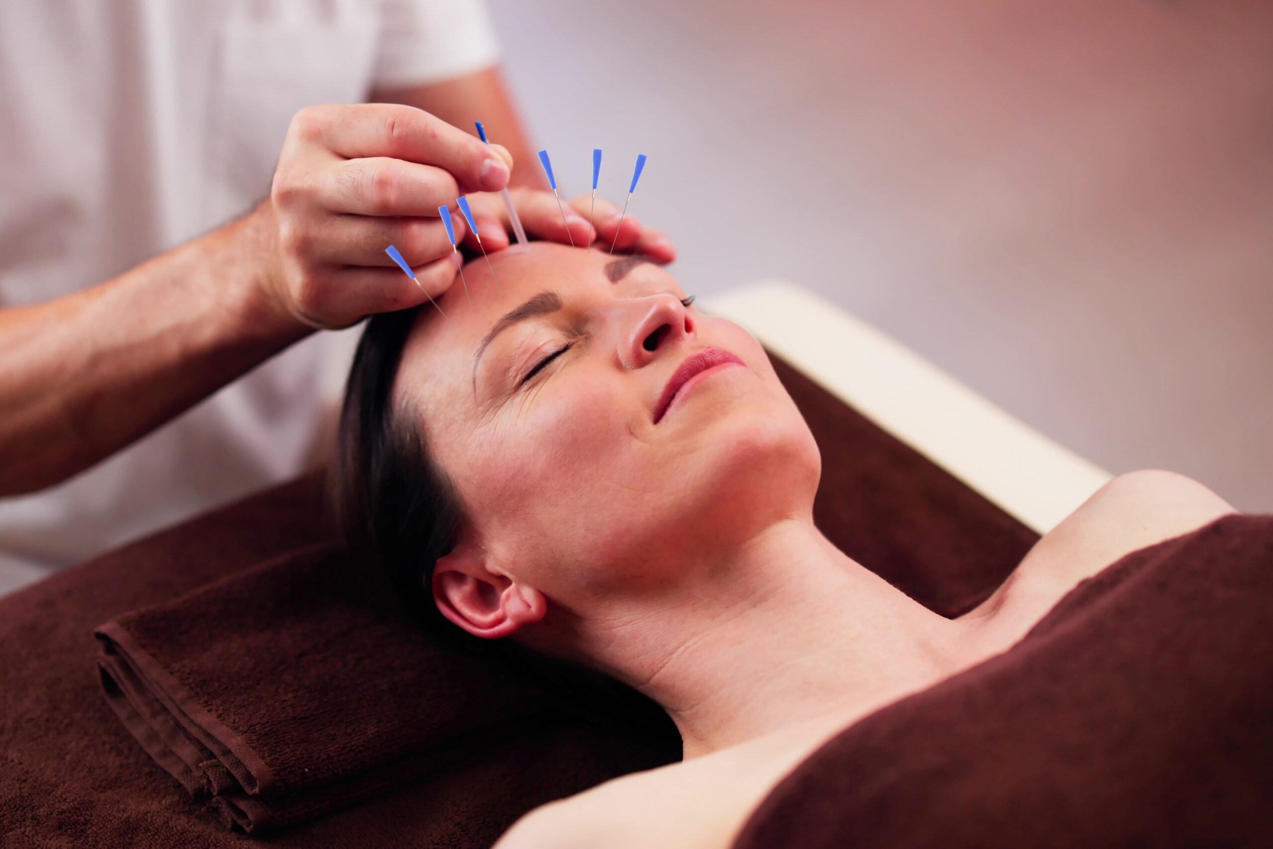 Acupuncture for Stress and Migraines Relief – Natural Treatment to Reduce Headache Frequency