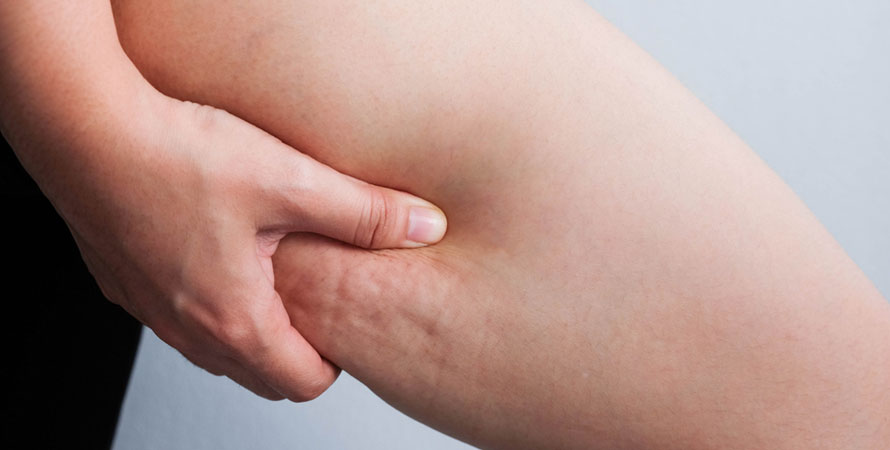 Cellulite Problem