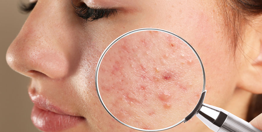 Hormonal Acne Symptoms