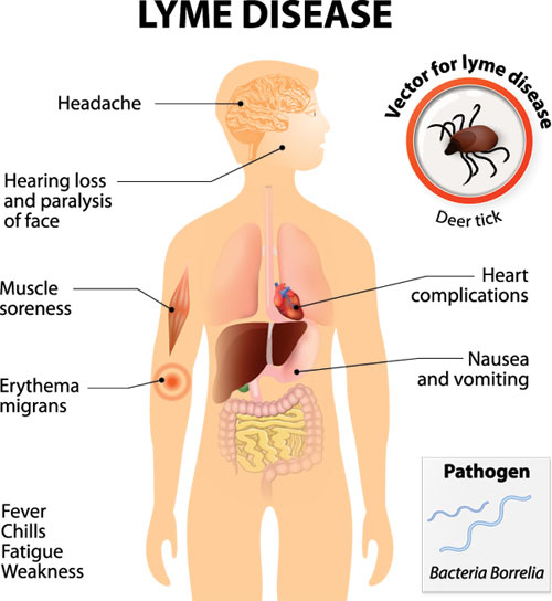 lyme disease Info