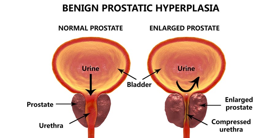 Ways to Reduce Prostate Enlargement Naturally
