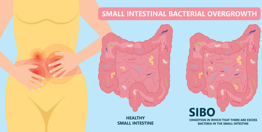SIBO Symtoms