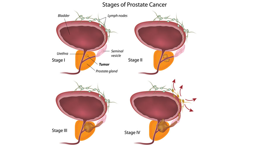 Stages of prostate cancer