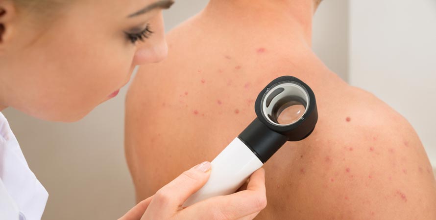 Treat Back Acne